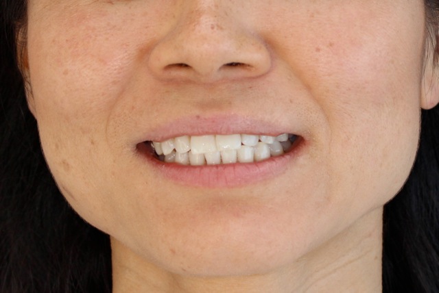 Le blanchiment dentaire par gouttières après un traitement d