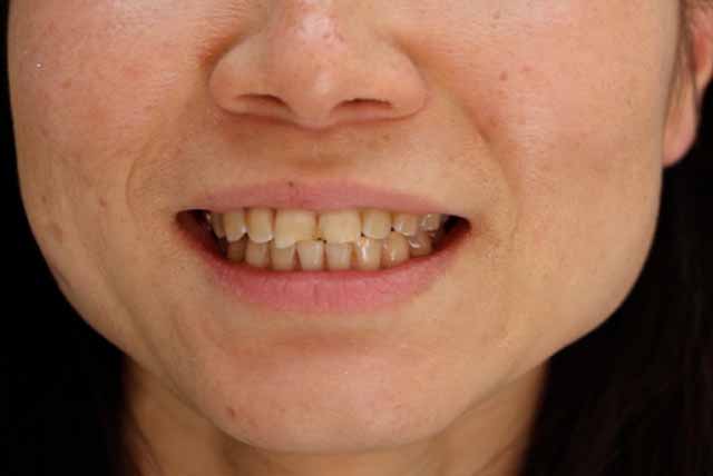 Blanchiment des dents avec gouttière (dents jaunes) à Paris