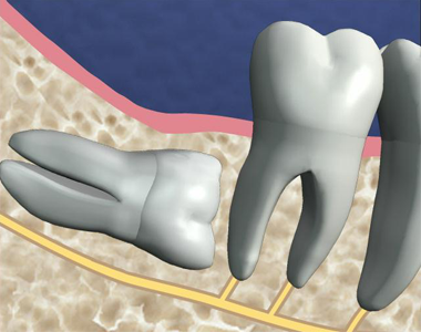 Dents de sagesse : faut-il les extraire ou non ?